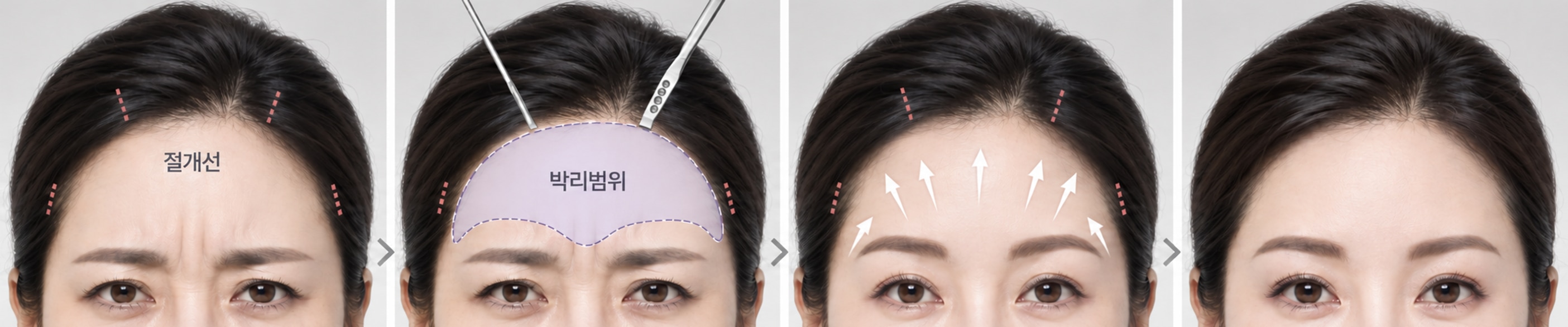 Ilustrasi Penjelasan Prosedur Facelift
