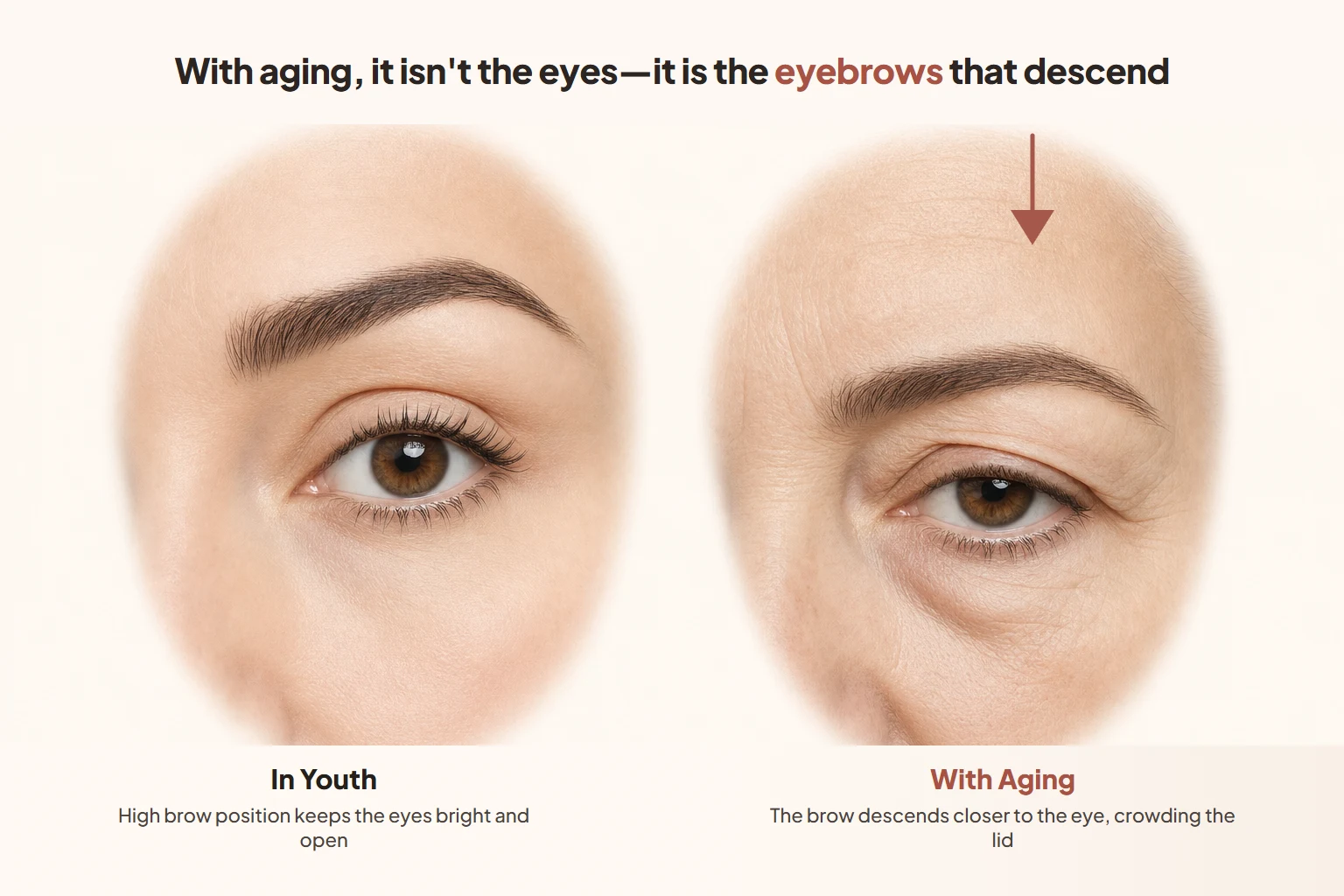 With aging, it isn't the eyes—it is the eyebrows that descend