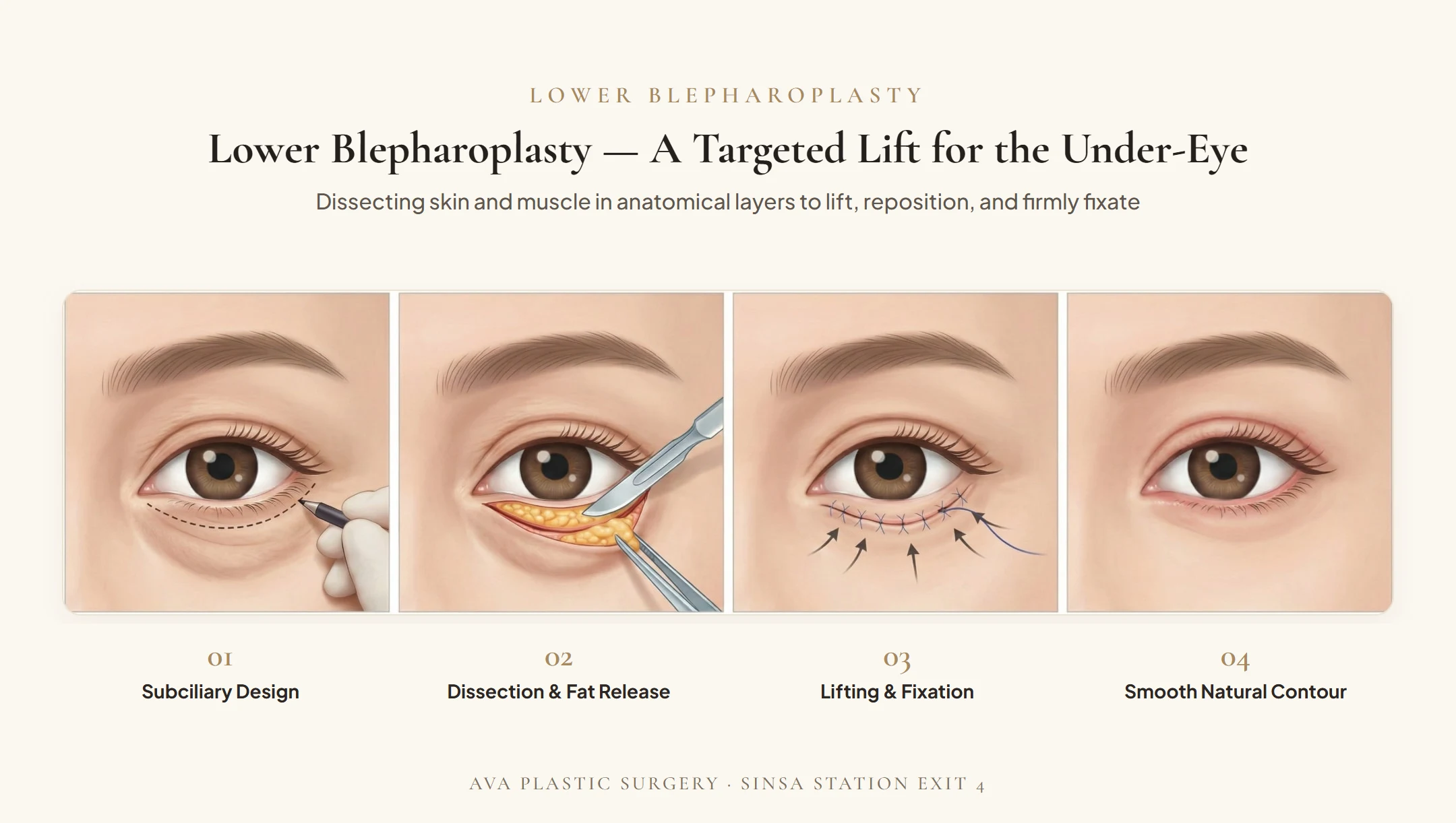 Lower Blepharoplasty 4-Step Surgical Diagram