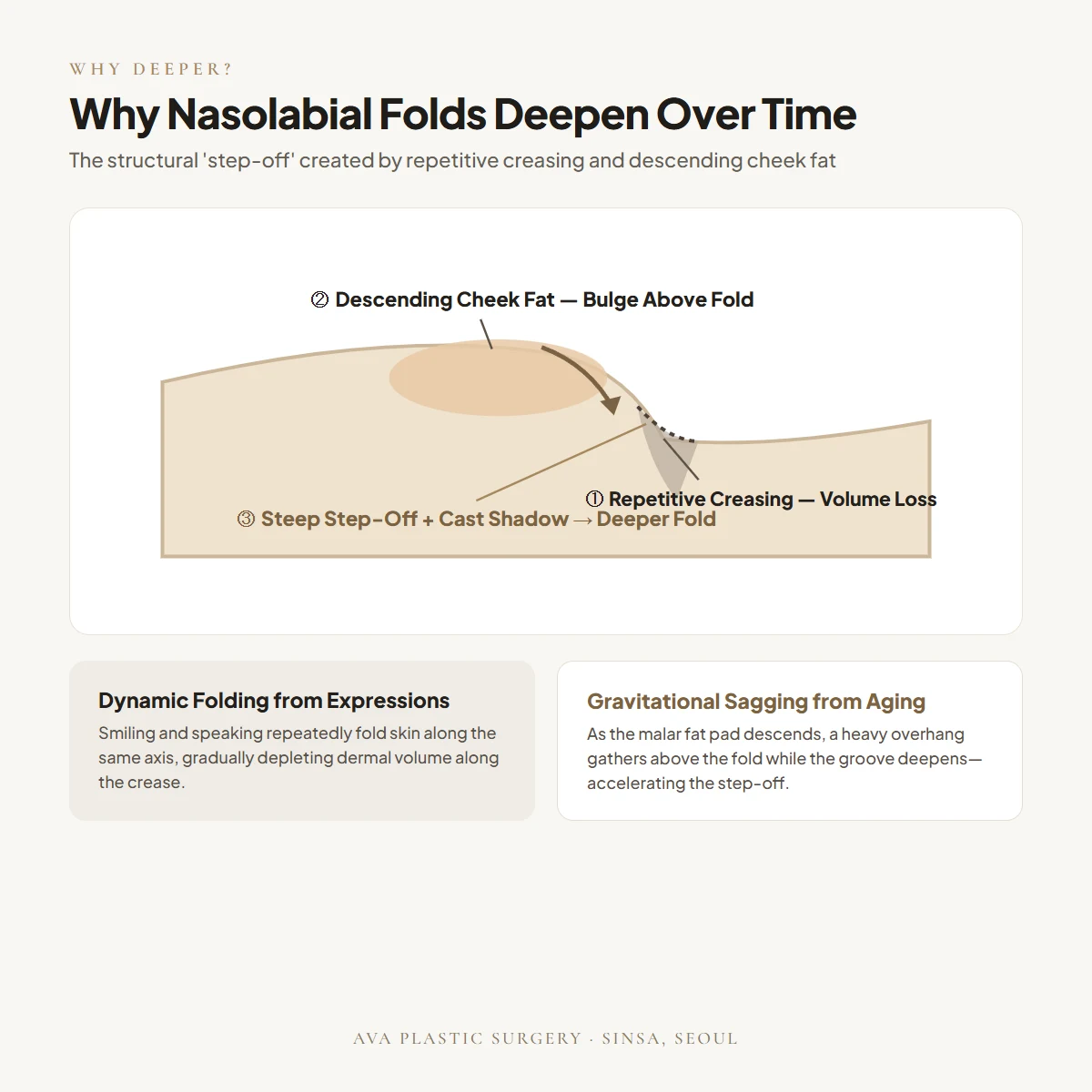 Why Nasolabial Folds Deepen Over Time — The Step-Off Mechanism