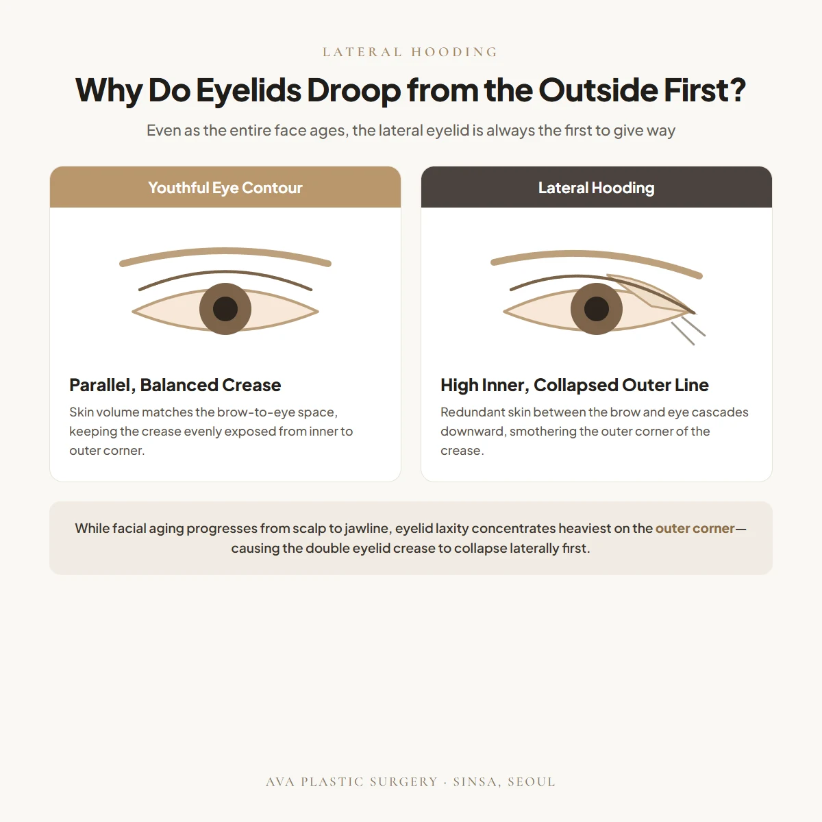 Lateral Hooding: Why Eyelids Droop from the Outside First