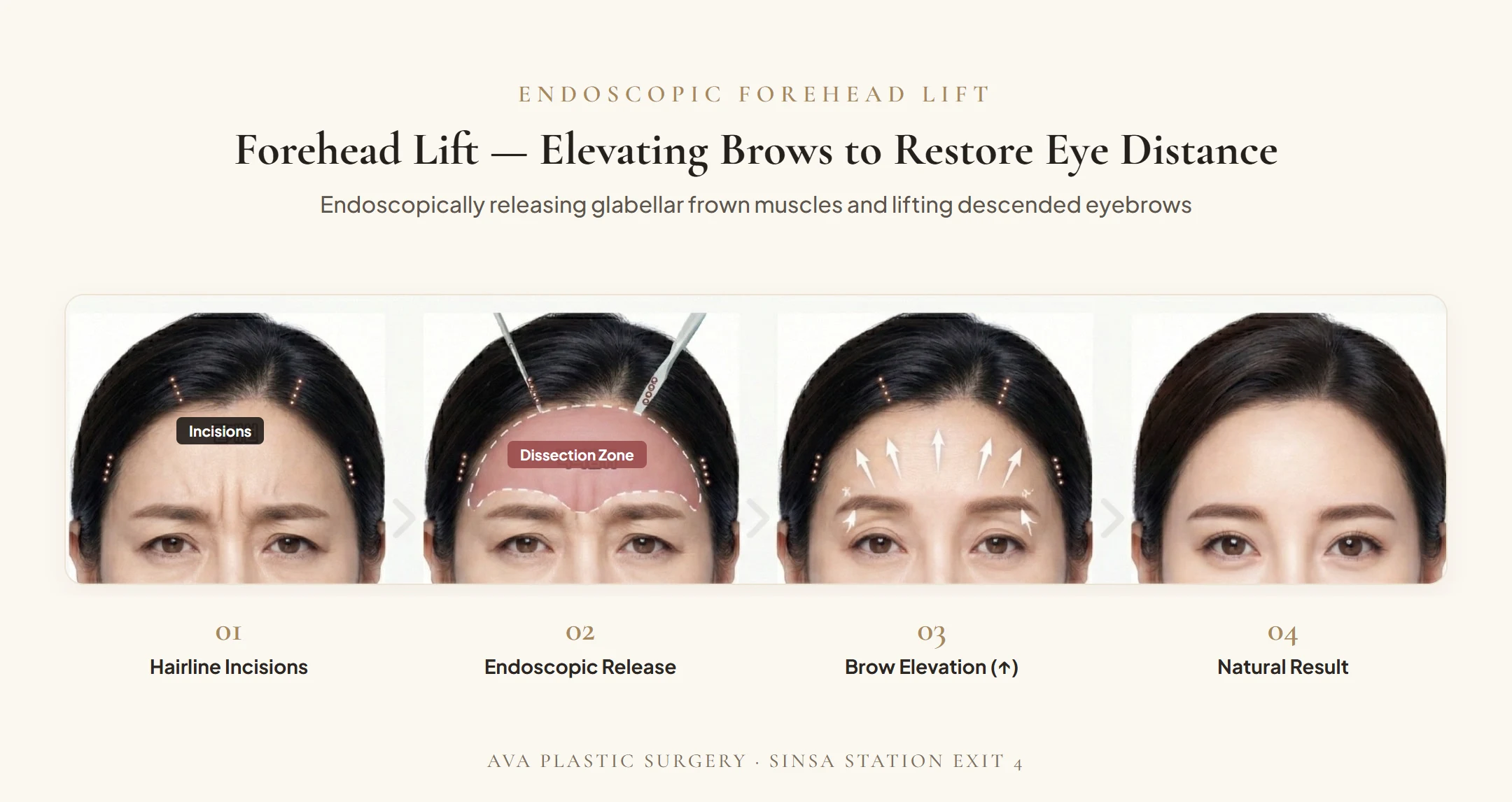 Endoscopic Forehead Lift 4-step surgical diagram