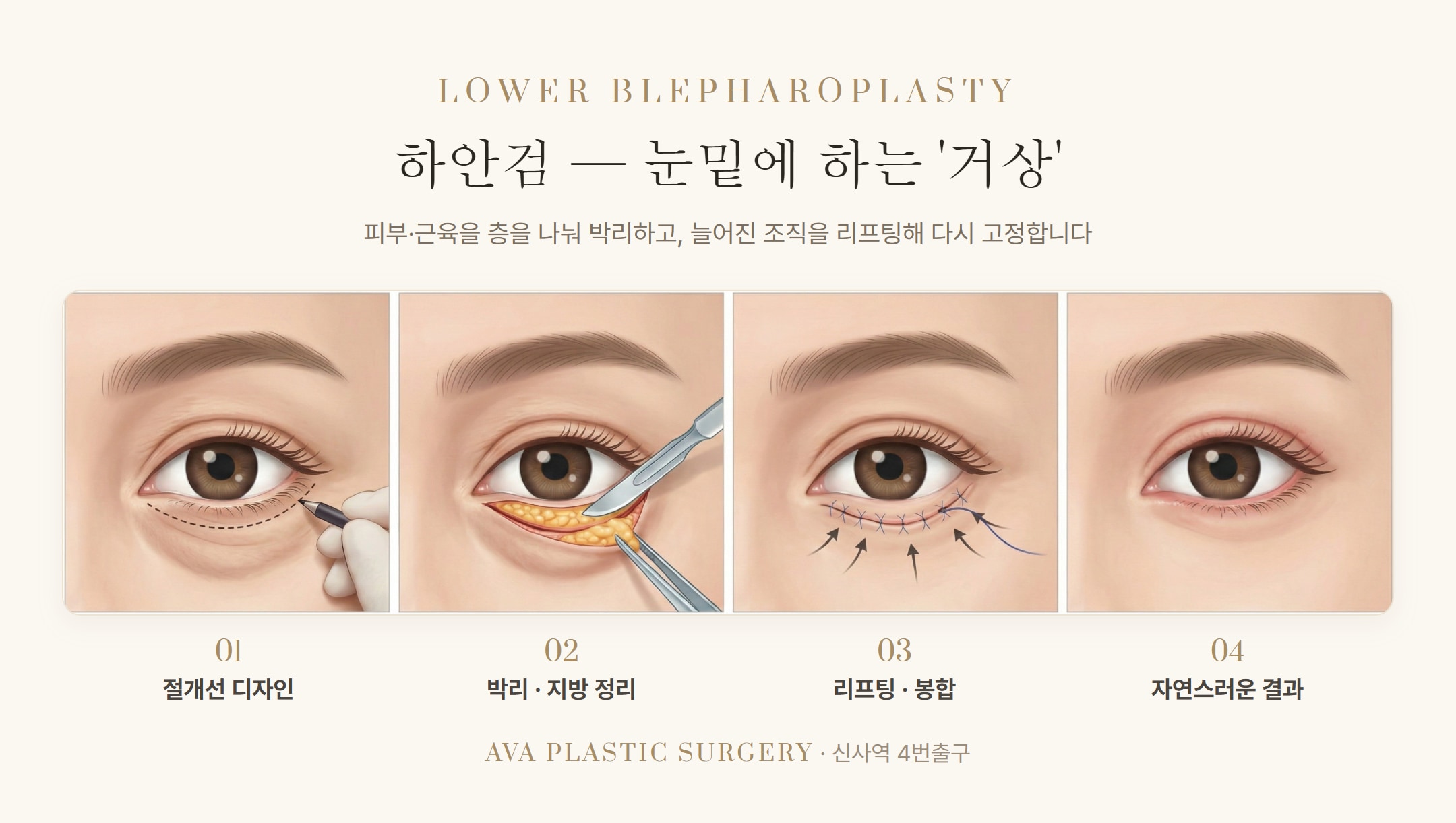 하안검 vs 눈밑지방재배치 — 나는 어떤 눈밑 수술? '30대 중반'이 분기점입니다 — 원문 이미지 5