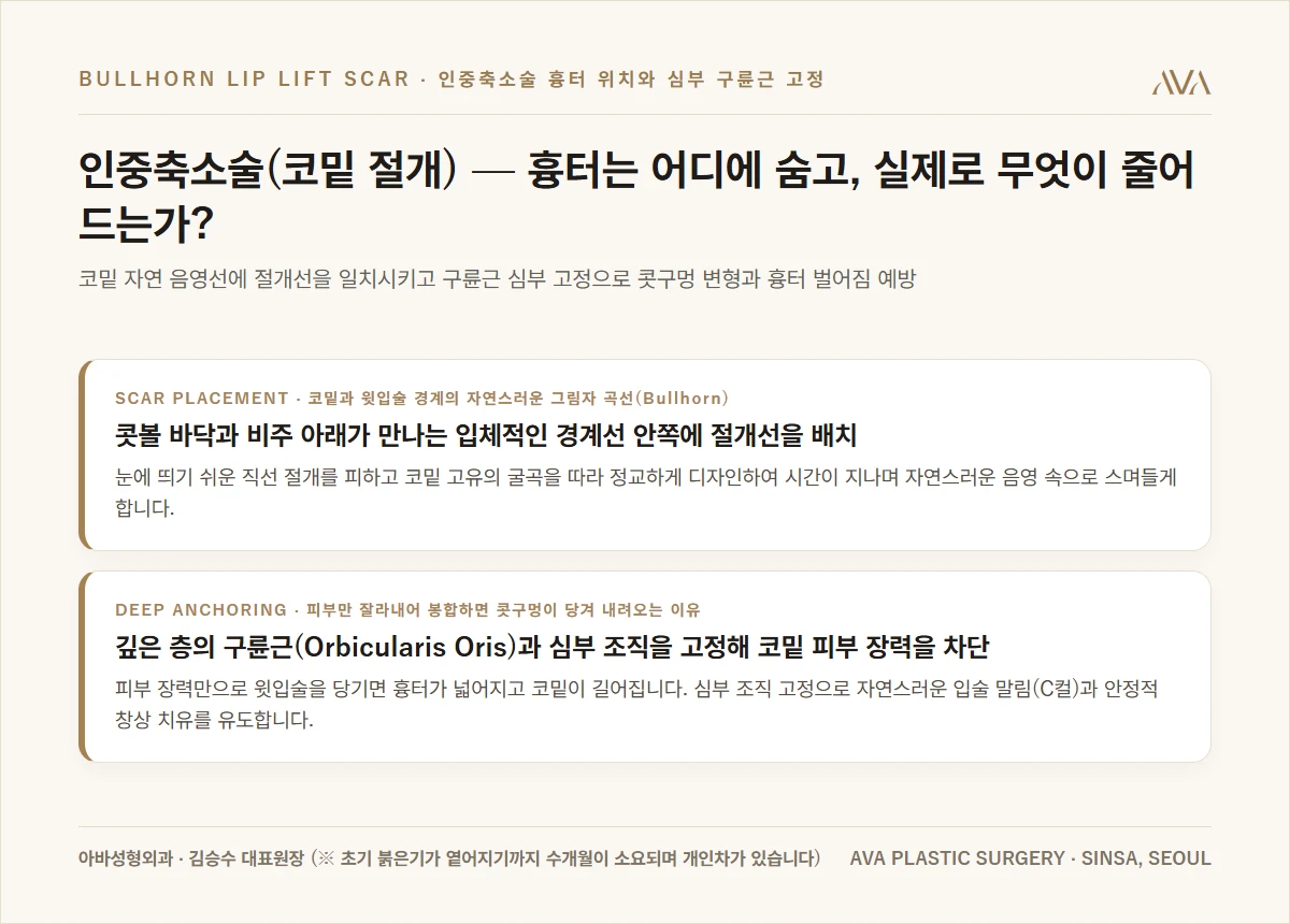 인중축소술 코밑 음영 절개와 심부 구륜근 고정 요약 카드