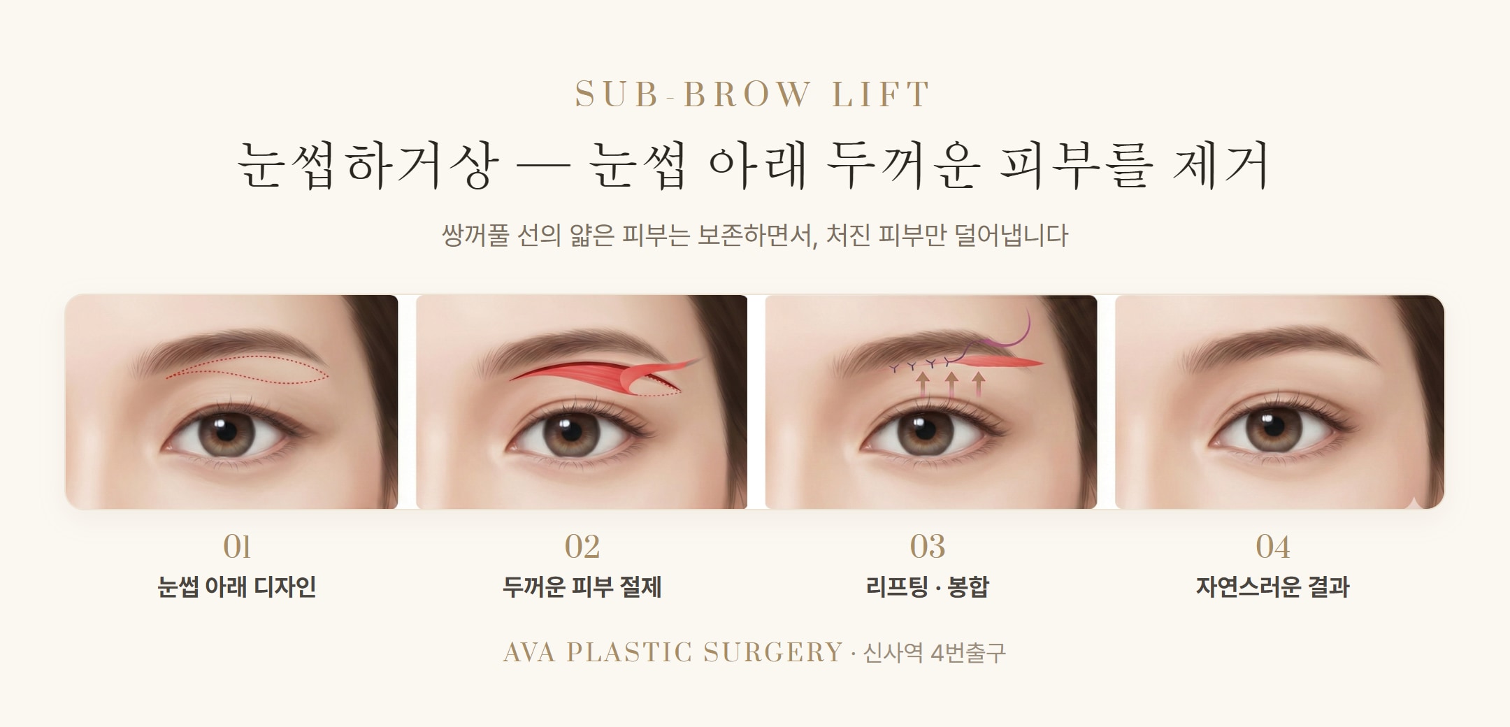 상안검·눈썹하거상·이마거상·쌍꺼풀 — 윗 눈꺼풀 처짐, 내 경우엔 어떤 조합일까 — 원문 이미지 5