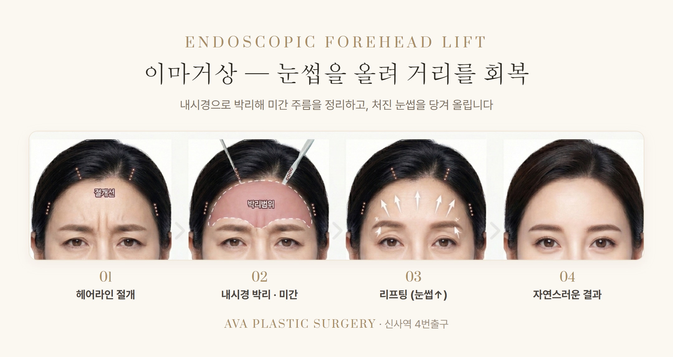 상안검·눈썹하거상·이마거상·쌍꺼풀 — 윗 눈꺼풀 처짐, 내 경우엔 어떤 조합일까 — 원문 이미지 7