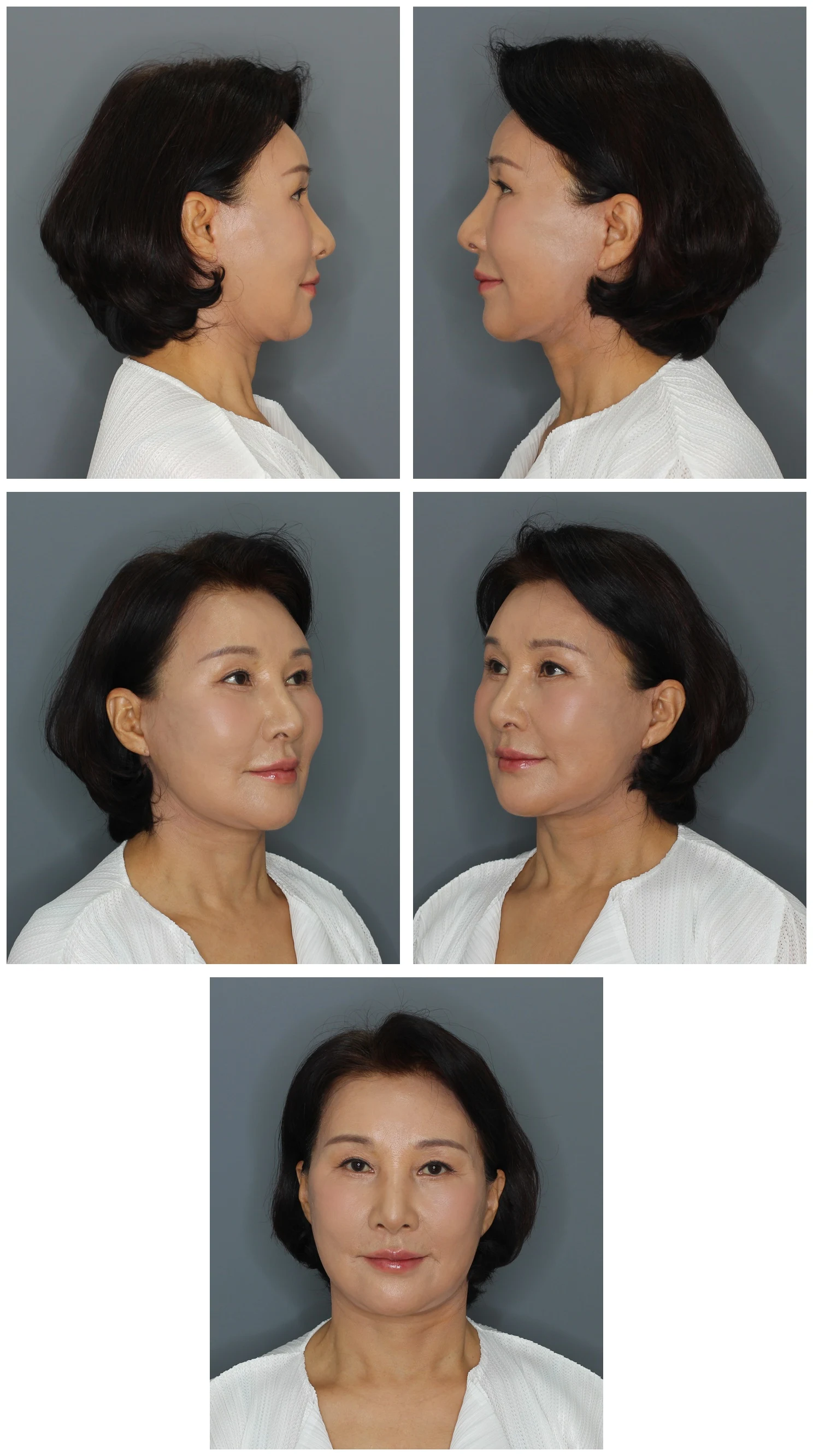 2 months after Deep-Plane Facelift and Eyelid Surgery — Dr. Kim's mother