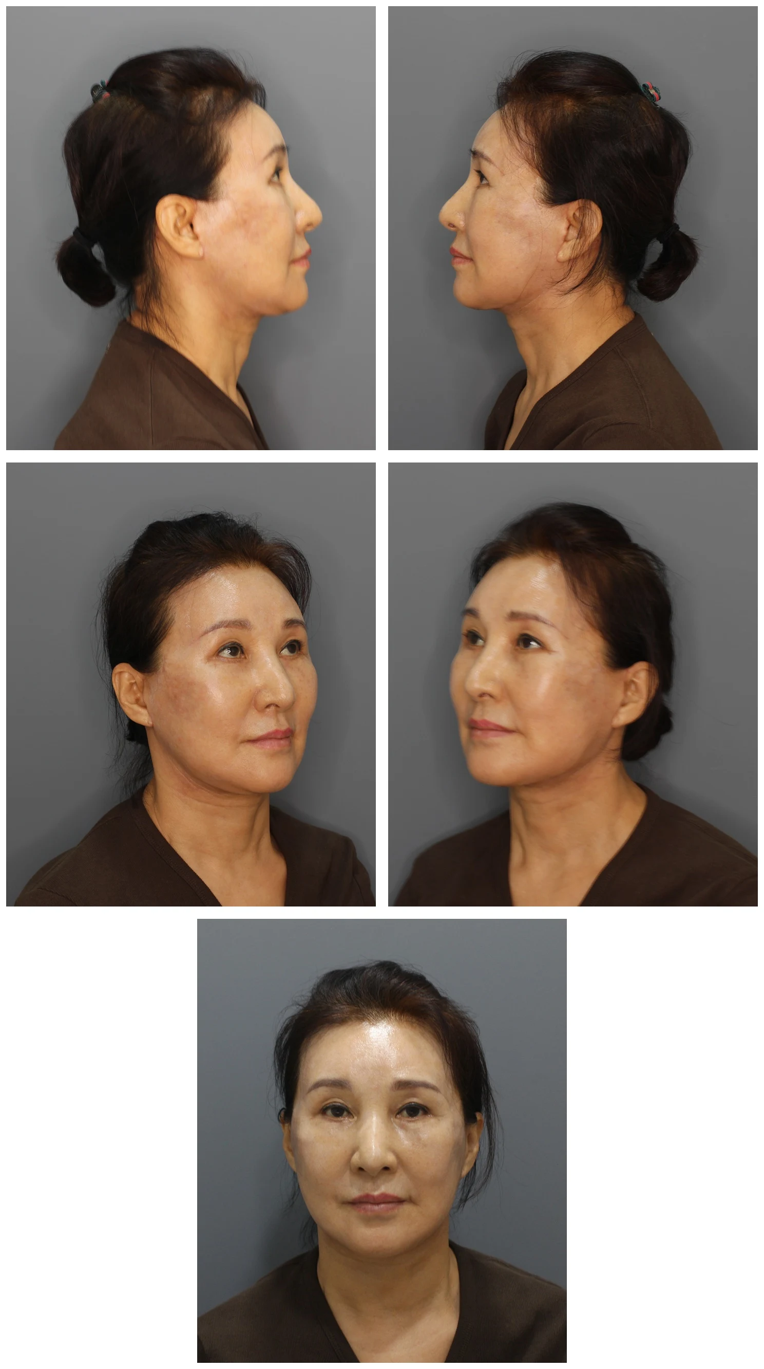 6 weeks after Deep-Plane Facelift and Eyelid Surgery — Dr. Kim's mother