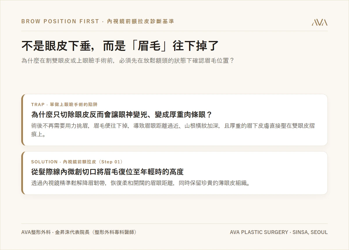 內視鏡前額拉皮（提眉） — 不是您的眼皮下垂，而是「眉毛」掉下來了