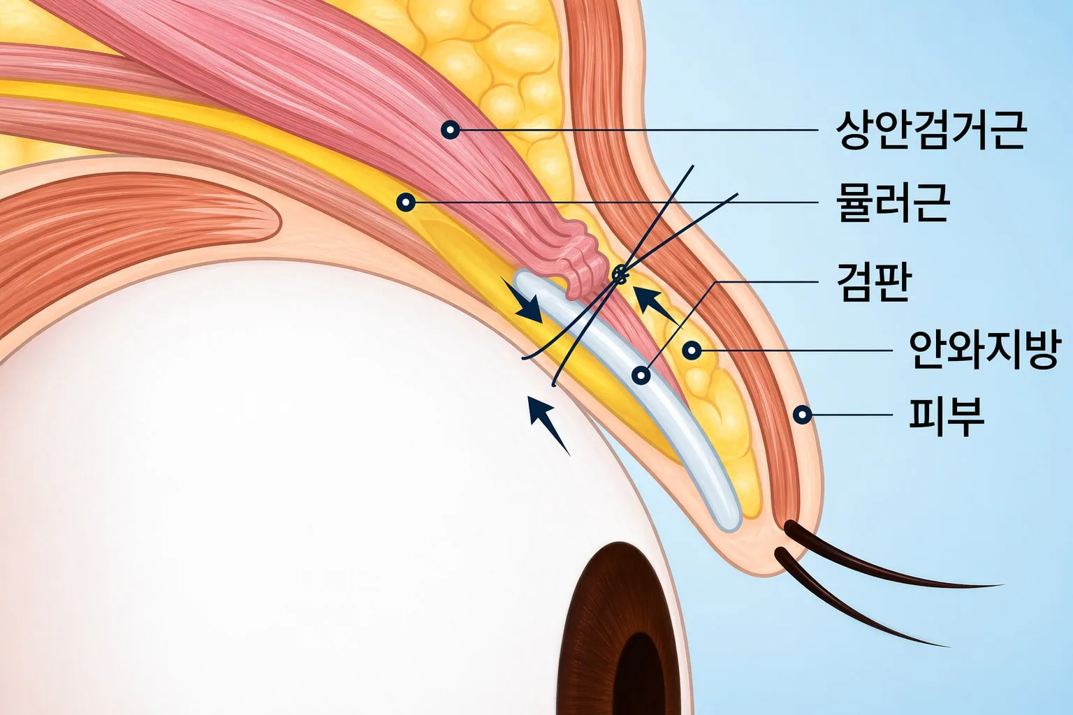 눈성형 설명 이미지