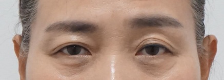 Eye surgery before