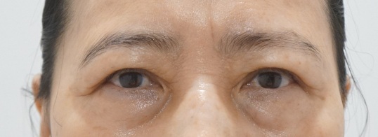 Eye surgery before