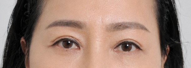 Eye surgery after