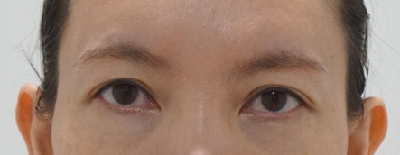 Eye surgery before