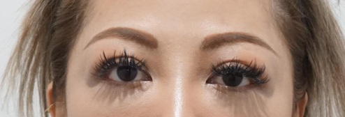 Eye surgery before