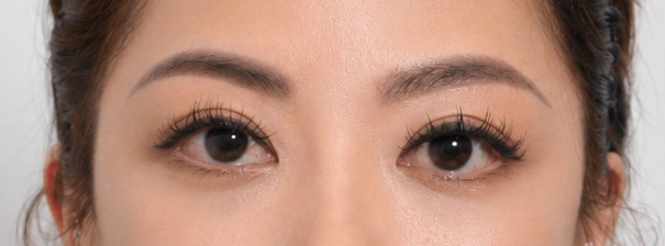 Eye surgery after